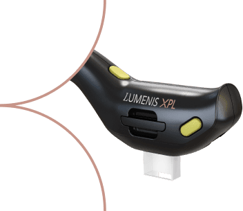 Black Lumenis XPL™ handpiece