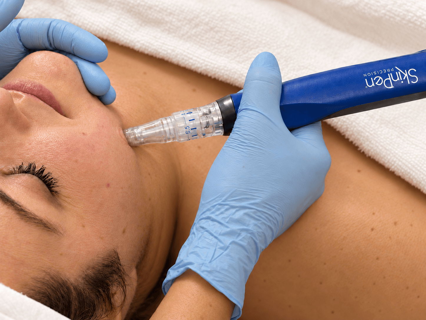 A microneedling pen with its needle cartridge